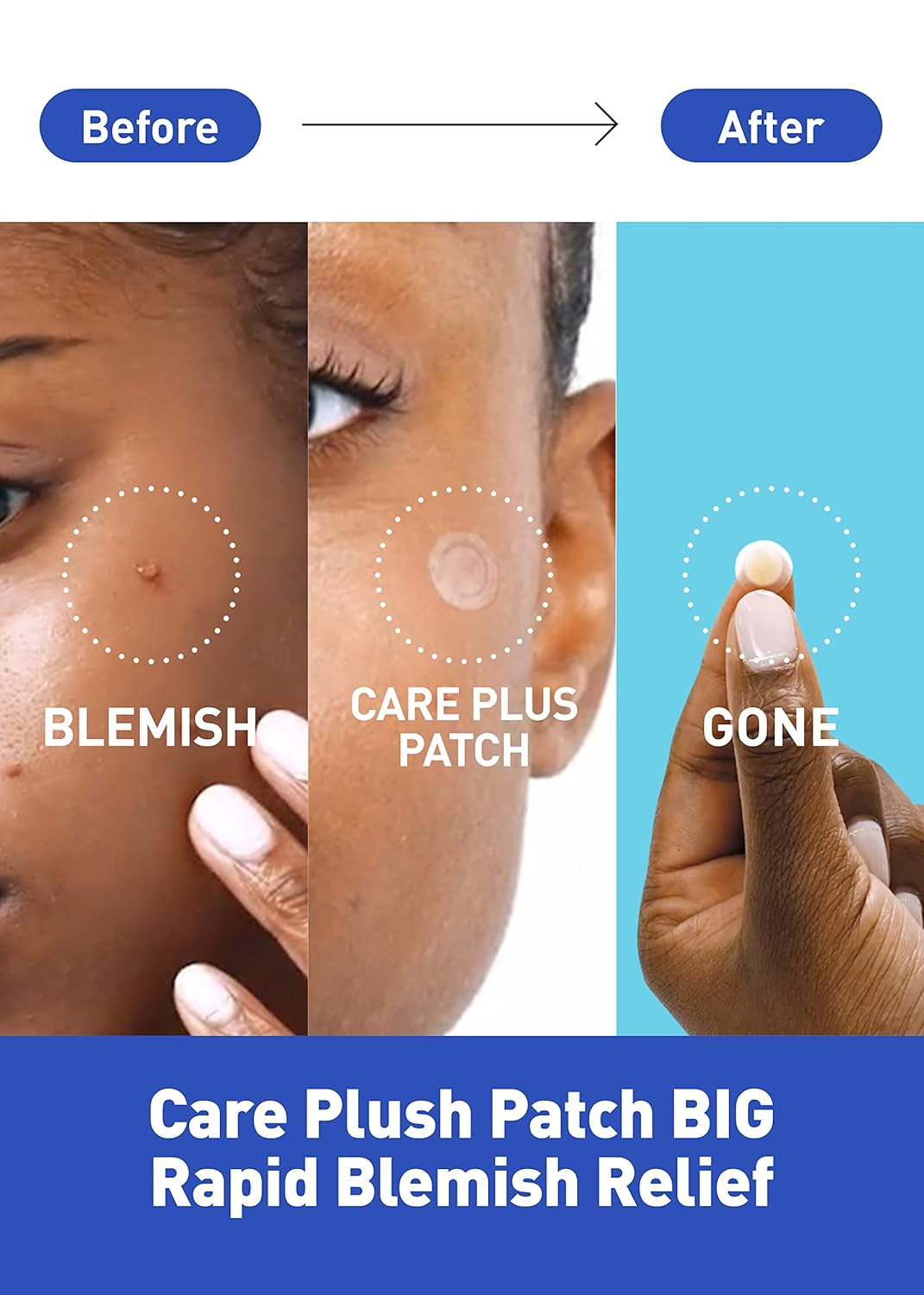 Care plus Spot Patch | Hydrocolloid Acne Korean Spot Patch to Cover Zits, Pimples and Blemishes, for Troubled Skin and Face (Hydrocolloid, 306 Count (Pack of 3))